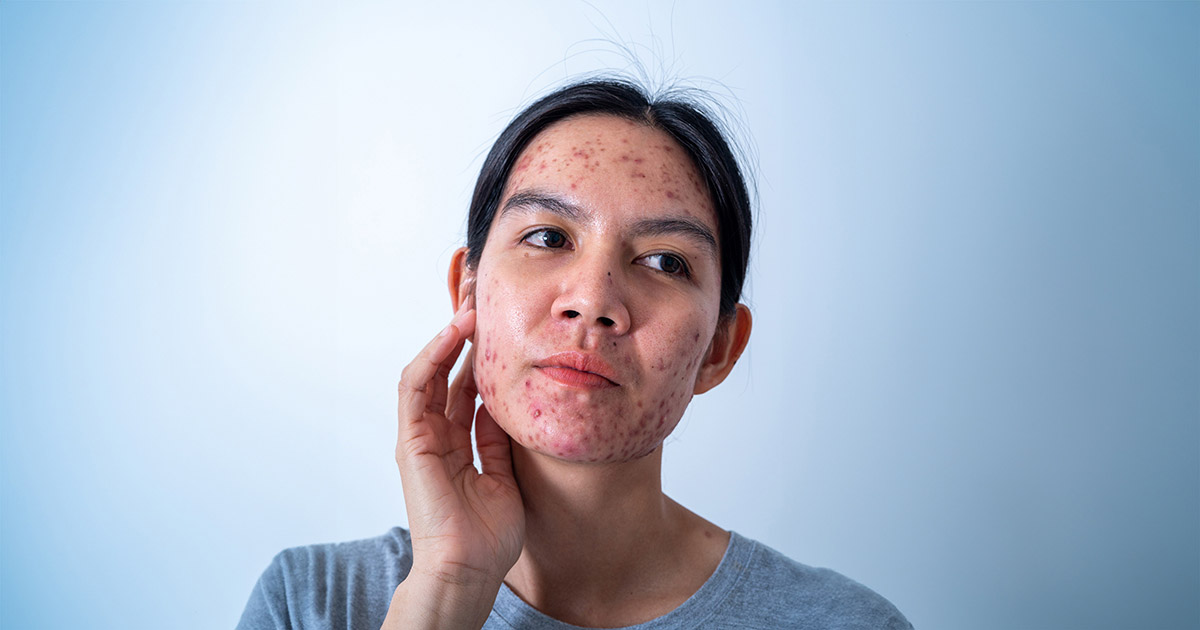 Young woman with acne before